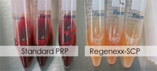 Regenexx-PRP is free of red or white blood cell contamination